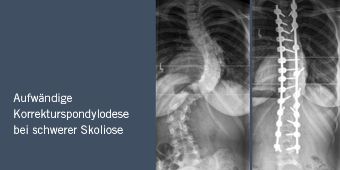 Röntgenbild Korrekturspondylodese