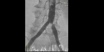 Angiogramm Gefäßenge einer Beckenarterie
