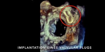 Bild: Implantation eines Valvular-Plugs