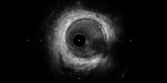 Bild: Intravaskulärer Ultraschall