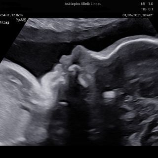 Sonographie Bild 