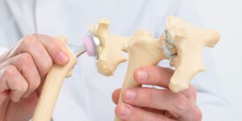 Hüftearthrose: Modell mit Implantatversorgung